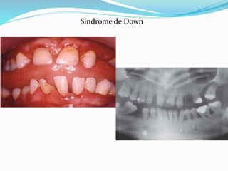 Síndrome de Down
 