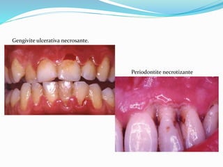 Gengivite ulcerativa necrosante.
Periodontite necrotizante
 