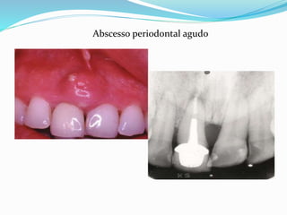 Abscesso periodontal agudo
 