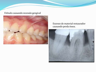 Frênulo causando recessão gengival
Excesso de material restaurador
causando perda óssea.
 
