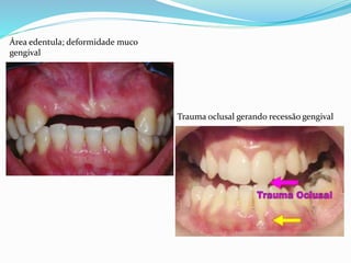 Trauma oclusal gerando recessão gengival
Área edentula; deformidade muco
gengival
 