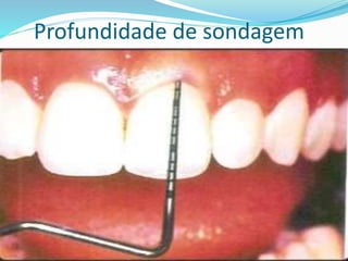 Profundidade de sondagem
 
