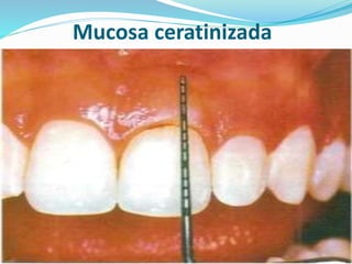 Mucosa ceratinizada
 