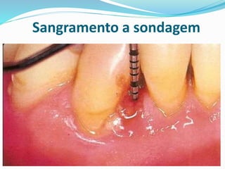 Sangramento a sondagem
 