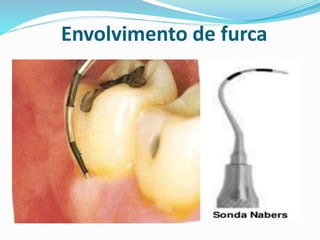 Envolvimento de furca
 