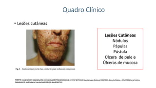 Quadro Clínico
• Lesões cutâneas
Lesões Cutâneas
Nódulos
Pápulas
Pústula
Úlcera de pele e
Úlceras de mucosa
FONTE: CASE REPORT DISSEMINATED CUTANEOUS CRYPTOCOCCOSISIN A PATIENT WITH AIDS Sandra Lopes Mattos e DINATO(1), Marcelo Mattos e DINATO(2), Carla Patrícia
NAKANISHI(3), José Roberto Paes de ALMEIDA(4) & Ney ROMITI(5)
 