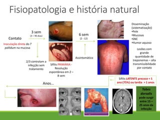 Fisiopatologia e história natural
Contato
3 sem
(3 – 90 dias) 6 sem
(2 - 12)
Sífilis PRIMÁRIA -
Resolução
espontânea em 2 –
8 sem
Inoculação direta do T
pallidum na mucosa
2/3 controlam a
infeçção sem
tratamento
Disseminação
(sistematização)
•Pele
•Mucosas
•SNC
•Humor aquoso
Lesões com
grande
quantidade de
treponemas – alta
transmissibilidade
por contato
Anos...
Tabes
dorsalis
pode surgir
entre 15 –
25 anos da
infecção
Sífilis LATENTE precoce < 1
ano (75%) ou tardia > 1 anos
Assintomático
 