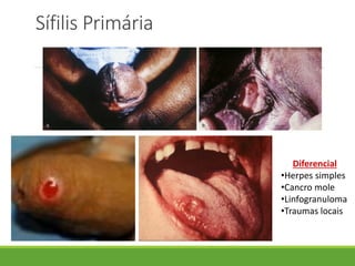 Sífilis Primária
Diferencial
•Herpes simples
•Cancro mole
•Linfogranuloma
•Traumas locais
 