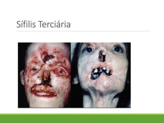 Sífilis Terciária
 