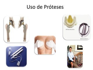 Uso de Próteses
 
