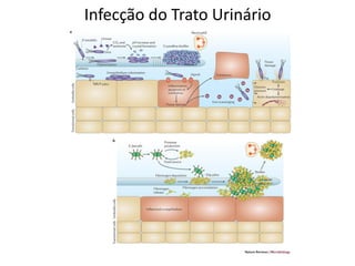 Infecção do Trato Urinário
 