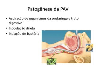 Patogênese da PAV
• Aspiração de organismos da orofaringe e trato
digestivo
• Inoculação direta
• Inalação de bactéria
 