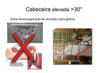 Cabeceira elevada >30°
Evitar broncoaspiração de secreção supra glótica
 