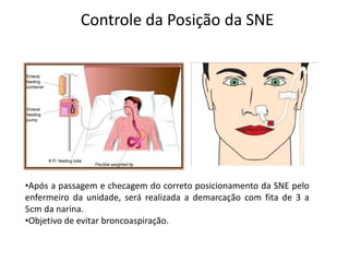 Controle da Posição da SNE
•Após a passagem e checagem do correto posicionamento da SNE pelo
enfermeiro da unidade, será realizada a demarcação com fita de 3 a
5cm da narina.
•Objetivo de evitar broncoaspiração.
 