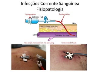 Infecções Corrente Sanguínea
Fisiopatologia
 