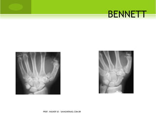Â NGULO   DE   A BDUÇÃO
                                              Q UADRIL




PROF. VAGNER SÁ - SAVAGNER@IG.COM.BR
 