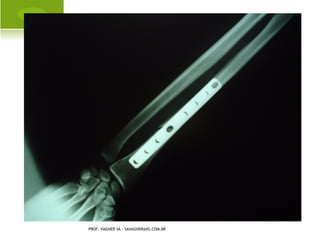 P OLIDACTILIA




PROF. VAGNER SÁ - SAVAGNER@IG.COM.BR
 