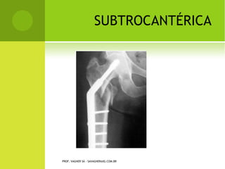 F ÊMUR C URTO C ONGÊNITO




PROF. VAGNER SÁ - SAVAGNER@IG.COM.BR
 