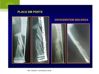 F ÊMUR C URTO C ONGÊNITO
C IRURGIA PARA P ROTETIZAÇÃO




 PROF. VAGNER SÁ - SAVAGNER@IG.COM.BR
 
