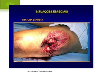 T ÍBIA VARA C ONGÊNITA




PROF. VAGNER SÁ - SAVAGNER@IG.COM.BR
 