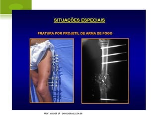 G ENO VALGO BILATERAL




PROF. VAGNER SÁ - SAVAGNER@IG.COM.BR
 