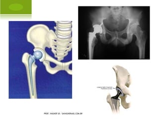 P É TORTO C ONGÊNITO




PROF. VAGNER SÁ - SAVAGNER@IG.COM.BR
 