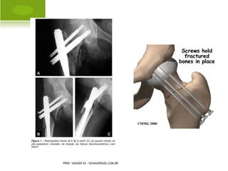 P É TORTO C ONGÊNITO
                                       C IRURGIA




PROF. VAGNER SÁ - SAVAGNER@IG.COM.BR
 