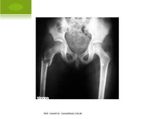 H ÁLUX VALGO A DQUIRIDO




PROF. VAGNER SÁ - SAVAGNER@IG.COM.BR
 