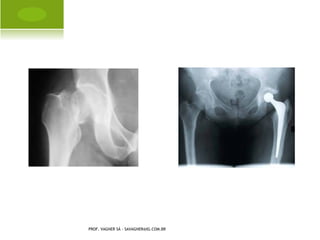 A MPUTAÇÃO C ONGÊNITA P É




PROF. VAGNER SÁ - SAVAGNER@IG.COM.BR
 