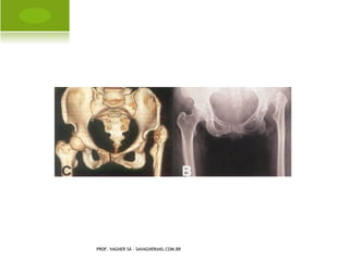B ANDA              DE   C ONSTRICÇÃO
                                                   P ERNA




PROF. VAGNER SÁ - SAVAGNER@IG.COM.BR
 