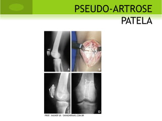C LASSIFICAÇÃO

a) Raquitismo carencial: deficiência de
   vitamina D, cálcio e fosfato.
b) Raquitismo secundário a
   tubulopatias renais.
c) Raquitismo associado a má absorção
   gastrintestinal.
d) Raquitismo secundário a distúrbios
   do metabolismo da vitamina D.
PROF. VAGNER SÁ - SAVAGNER@IG.COM.BR
 