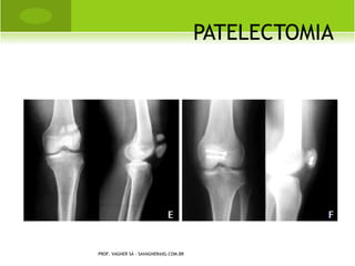 A SPECTOS C LÍNICOS
   Irritabilidade / apatia
   Achatamento do crânio
   Alargamento da porção cartilaginosa das suturas do crânio
   Dentinogênese retardada ou defeituosa
   Articulações costocondrais proeminentes (rosário raquítico)
   pectus carinatum
   Fraqueza muscular, Distensão abdominal, Frouxidão ligamentar
   Encurvamento dos ossos longos
   Cifoscoliose
   Baixa estatura, secundária as deformidades ósseas
                   PROF. VAGNER SÁ - SAVAGNER@IG.COM.BR
 