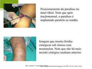 E SCORBUTO
       Deficiência de ácido levoexurônico (ácido ascórbico –
        vitamina C).
       Altera a formação de colágeno e a resistência dos
        capilares que orientam a mineralização óssea.
       O quadro clínico inclui: irritabilidade, parestesias,
        hipotonia muscular principalmente dos membros
        inferiores, obrigando o paciente a permanecer com as
        articulações fletidas. Também encontra-se febre e
        hemorragias das gengivas e do tecido subcutâneo
        além de dor óssea e articular.
       O tratamento é relativamente simples com ingesta de
        vitamina C, principalmente porque doses maciças não
        levam a intoxicação. Se o tratamento for instituído no
        início, provavelmente não acarretará em seqüelas.

PROF. VAGNER SÁ - SAVAGNER@IG.COM.BR
 
