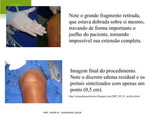 FATORES DE RISCO PARA A
               OSTEOPOROSE

   inatividade e sedentarismo
   má nutrição
   amenorréia induzida por excesso de
    exercício
   dieta com alta ingestão de fibras
   dieta com alta ingestão de fosfatos
   dieta com alta ingestão de proteínas

PROF. VAGNER SÁ - SAVAGNER@IG.COM.BR
 