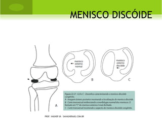 O UTRAS I NFORMAÇÕES

                                 QUADRO CLÍNICO
   A doença é assintomática, a não ser que ocorra uma fratura
   É muito importante avaliar a história para correlacionar com o
    uso de medicamentos como: corticóides, anticonvulsivos,
    medicação para tireóide, antiácidos e heparina.
                  LOCAIS COMUNS DE FRATURA
   Fratura por compressão vertebral
   Fratura do punho
   Fratura do quadril/fêmur proximal
   Fratura dos arcos costais, pelve e úmero
                PROF. VAGNER SÁ - SAVAGNER@IG.COM.BR
 