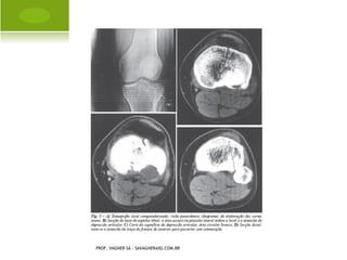 D ENSITOMETRIA Ó SSEA




PROF. VAGNER SÁ - SAVAGNER@IG.COM.BR
 