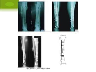 O STEOPOROSE




PROF. VAGNER SÁ - SAVAGNER@IG.COM.BR
 