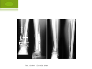 O STEOPOROSE




PROF. VAGNER SÁ - SAVAGNER@IG.COM.BR
 