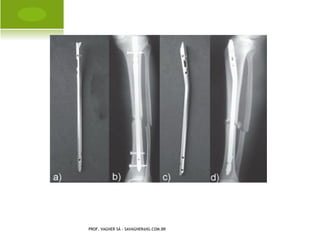 O STEOPOROSE - P REVENÇÃO




PROF. VAGNER SÁ - SAVAGNER@IG.COM.BR
 