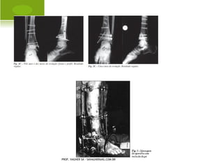 O STEÍTE      DEFORMANTE
                                           DOENÇA DE PAGET

       A doença de Paget é uma alteração do processo
        de remodelação do esqueleto, iniciada por um
        aumento da reabsorção óssea mediada pelos
        osteoclastos.

       A deformidade e o aumento de volume dos ossos
        pode causar compressão de estruturas nervosas
        adjacentes, como por exemplo, os pares
        cranianos causando diminuição da acuidade
        auditiva. A compressão de raízes nervosas pelo
        aumento de volume ósseo, pode ser a causa de
        lombalgia ou lombociatalgia, por estenose do
        canal vertebral ou do forame intervertebral.
    PROF. VAGNER SÁ - SAVAGNER@IG.COM.BR
 