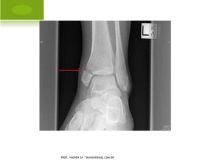 D ISTÚRBIOS I NFECCIOSOS E
INFLAMATÓRIOS DE O SSOS E
A RTICULAÇÕES




PROF. VAGNER SÁ -
SAVAGNER@IG.COM.BR
 
