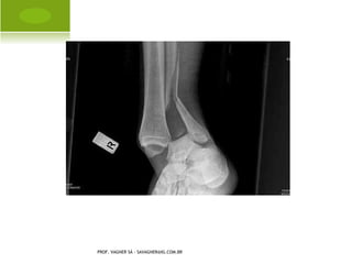 OSTEOMIELITE

                                      Infecção óssea
                                      Aguda, sub-aguda ou
                                       crônica




PROF. VAGNER SÁ - SAVAGNER@IG.COM.BR
 