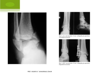 Q UADRO CLÍNICO


       Dor óssea (edema, calor, rubor)
       Febre
       Prostração
       Anorexia
       Impotência funcional


PROF. VAGNER SÁ - SAVAGNER@IG.COM.BR
 