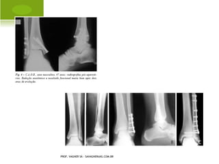 TRATAMENTO


   Identificação do agente
   Antibioticoterapia
   Antiinflamatórios
   Repouso
   Drenagem cirúrgica
   Suporte nutricional
    PROF. VAGNER SÁ - SAVAGNER@IG.COM.BR
 