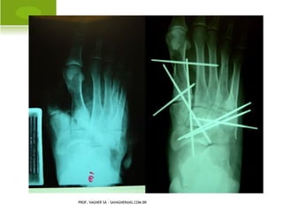 O STEOMIELITE CRÔNICA




PROF. VAGNER SÁ - SAVAGNER@IG.COM.BR
 