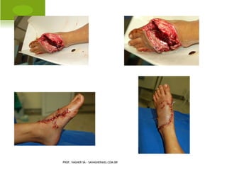 A RTRITE SÉPTICA

       É uma infecção de uma articulação
        causada por bactérias piogênicas,
        podendo levar a destruição da
        cartilagem, subluxação e até a perda
        da articulação.




PROF. VAGNER SÁ - SAVAGNER@IG.COM.BR
 