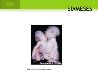 A RTRITE REUMATÓIDE
                A artrite reumatóide não é transmissível.
                 As causas da doença ainda não são
                 totalmente conhecidas. Porém, sabe-se
                 que o sistema imunológico exerce um
                 importante papel na inflamação e nos
                 danos das articulações. Na artrite
                 reumatóide, o sistema imunológico não
                 funciona corretamente e pode atacar as
                 próprias articulações e alguns órgãos do
                 corpo.



PROF. VAGNER SÁ - SAVAGNER@IG.COM.BR
 