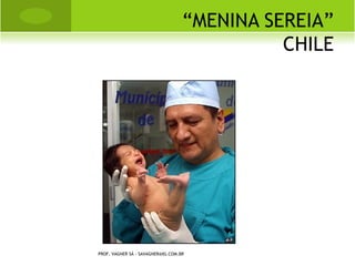 A RTRITE GOTOSA
   A gota é uma doença reumatológica, inflamatória
    e metabólica, que cursa com hiperuricemia
    (elevação dos níveis de ácido úrico no sangue) e
    é resultante da deposição de cristais do ácido nos
    tecidos e articulações.

   A forma primária é de causa desconhecida e tem
    algum componente genético (hereditário), sendo
    a mais comum. Já a gota secundária desenvolve
    em consequência de outra doença ou alguns
    medicamentos.

   A ingestão de bebida alcoólica e dieta rica em
    proteínas e gorduras é também uma causa
    comum de hiperuricemia, podendo causar a
    gota.
                                     PROF. VAGNER SÁ - SAVAGNER@IG.COM.BR
 