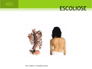 OSTEOCONDROSES


       Leg-Calvè-Perthes,

       Scheurmann,

        Sever,

       Osgood-Schlatter e

       Kienbock




PROF. VAGNER SÁ - SAVAGNER@IG.COM.BR
 