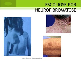 FASES                     LEGG - PERTHES - CALVÉ


   Inicial ou necrose óssea. Pela perda da vascularização
    da cabeça femoral, ocorre necrose (mortificação) em
    parte ou em toda a cabeça femoral.

   Fragmentação ou revascularização. Com a
    revascularização da cabeça femoral tem início a
    absorção do tecido necrosado, aparecendo áreas de
    fragmentação.

   Reossificação. Forma-se novo tecido ósseo.

   Deformidade residual ou cura sem seqüelas. Fase
    final.

    PROF. VAGNER SÁ - SAVAGNER@IG.COM.BR
 